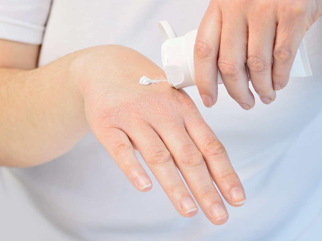 woman puts creamy lotion on her dry hand